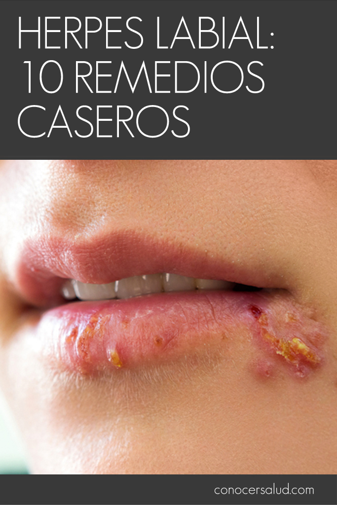 Herpes labial: 10 Remedios caseros