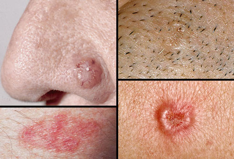 Estas son las señales de advertencia del cáncer de piel