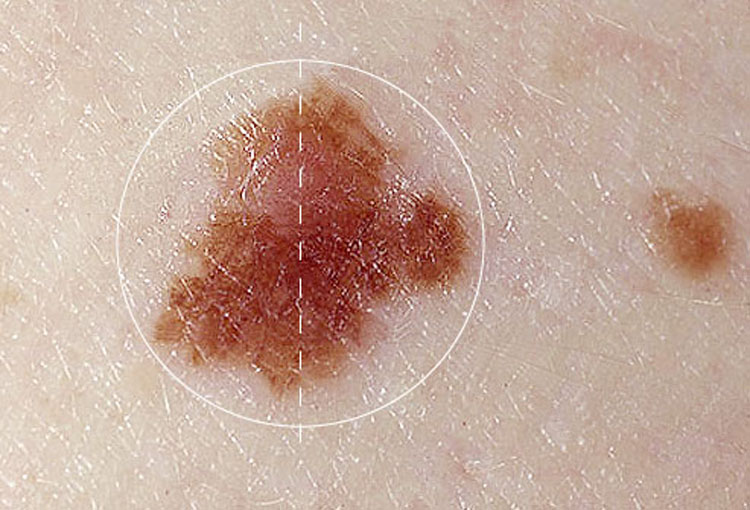 Estas son las señales de advertencia del cáncer de piel
