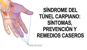 Síndrome del túnel carpiano: Síntomas, prevención y remedios caseros