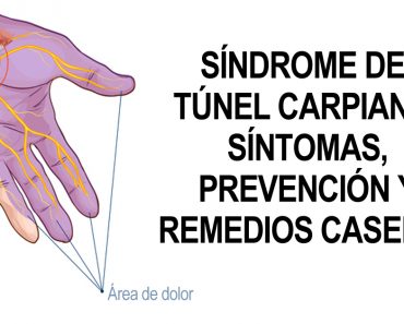 Síndrome del túnel carpiano: Síntomas, prevención y remedios caseros