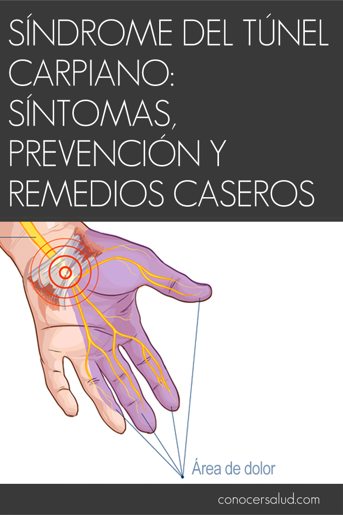 Síndrome del túnel carpiano: Síntomas, prevención y remedios caseros