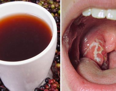 Faringitis estreptocócica: 10 remedios naturales