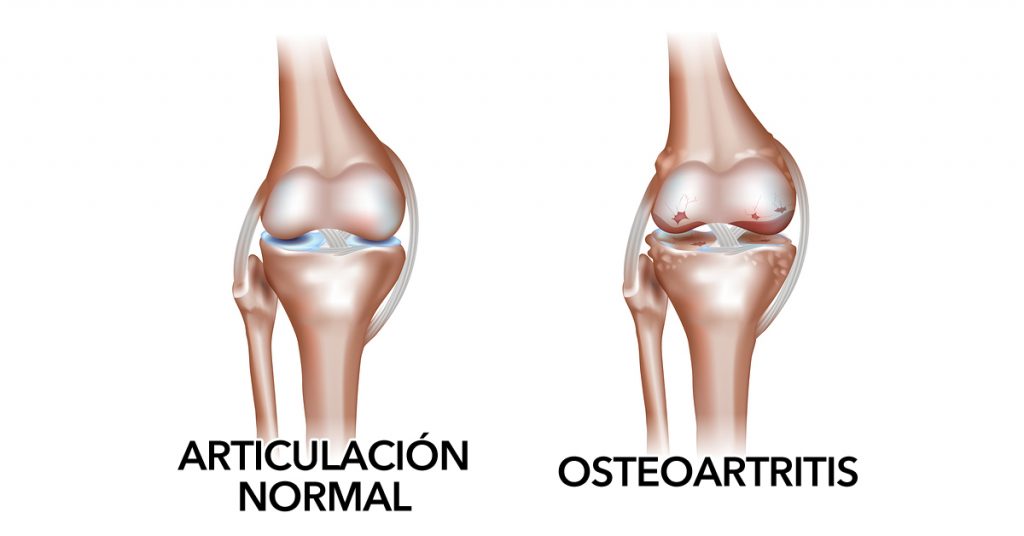 Tratamientos naturales para la osteoartritis (degeneración del cartílago articular)