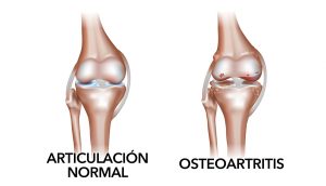 Tratamientos naturales para la osteoartritis (degeneración del cartílago articular)