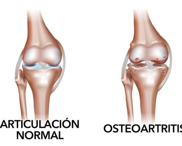 Tratamientos naturales para la osteoartritis (degeneración del cartílago articular)