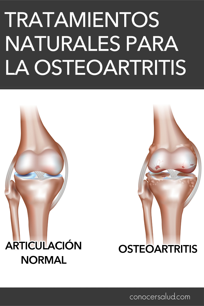 Tratamientos naturales para la osteoartritis (degeneración del cartílago articular)