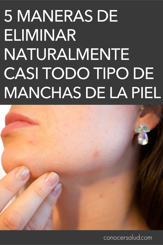 5 maneras de eliminar naturalmente casi todo tipo de manchas de la piel