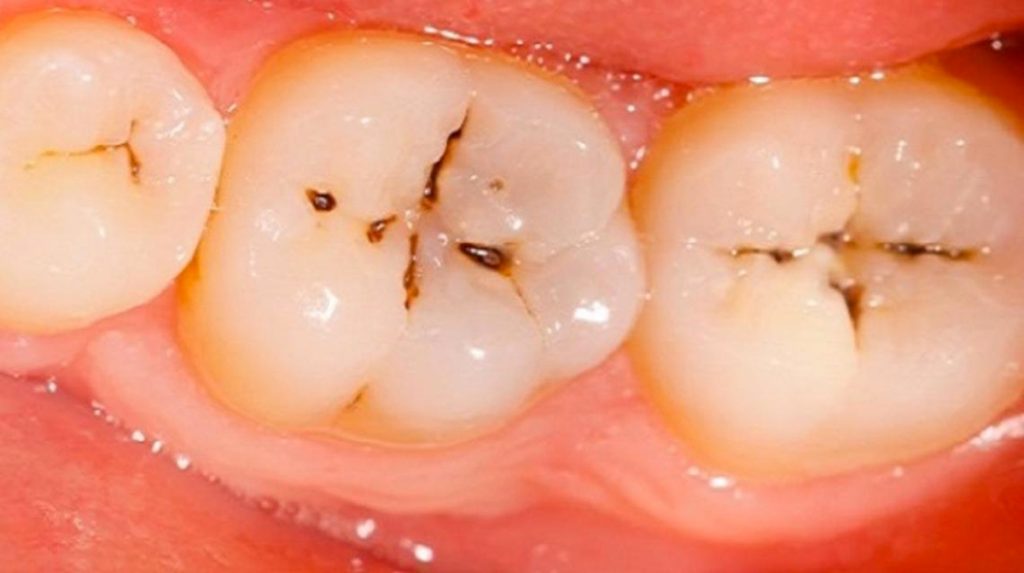 Formas naturales para prevenir y tratar las caries