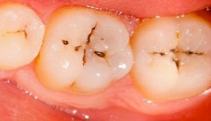 Formas naturales para prevenir y tratar las caries