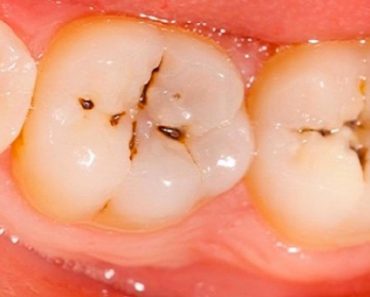 Formas naturales para prevenir y tratar las caries