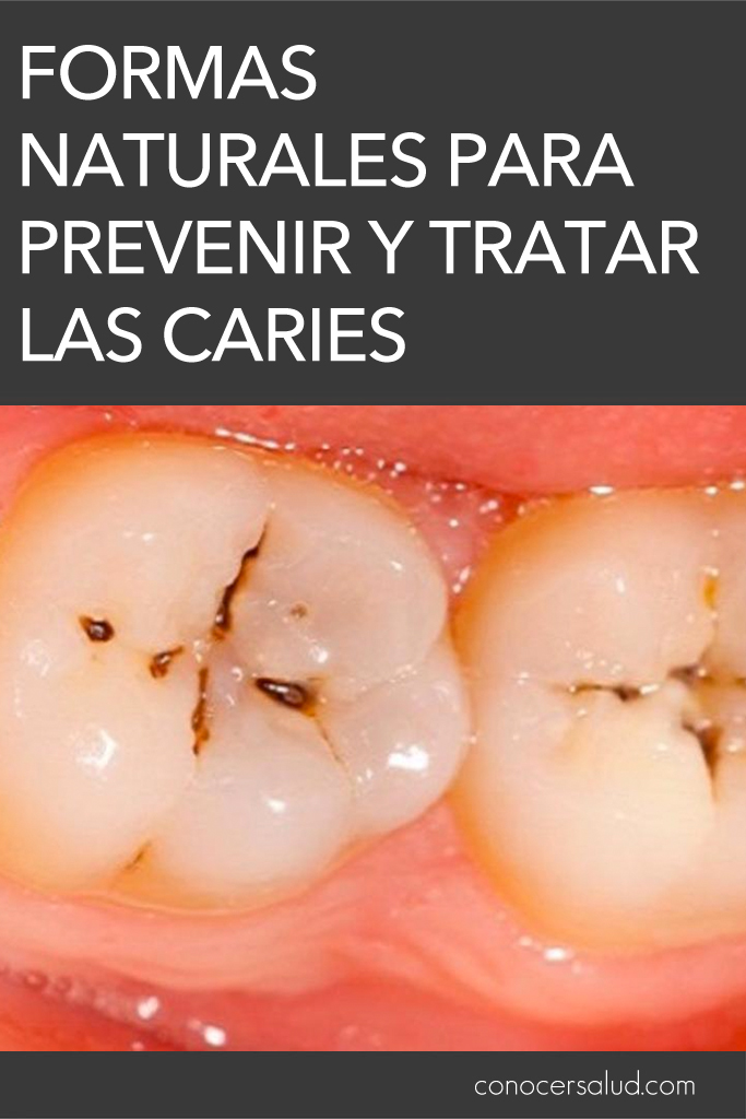 Formas naturales para prevenir y tratar las caries