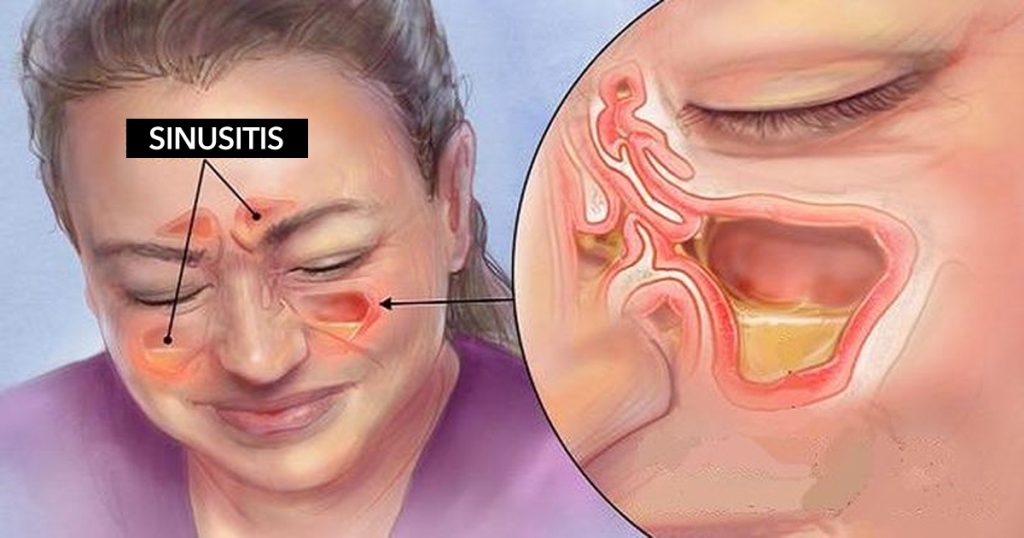 Estos aceites esenciales pueden aliviarle de la sinusitis