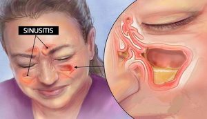 Estos aceites esenciales pueden aliviarle de la sinusitis