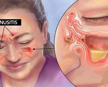 Estos aceites esenciales pueden aliviarle de la sinusitis