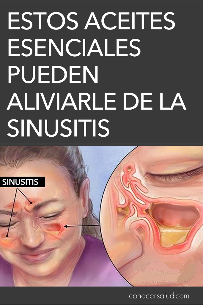 Estos aceites esenciales pueden aliviarle de la sinusitis