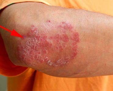 6 alimentos que debe evitar para prevenir los brotes de psoriasis