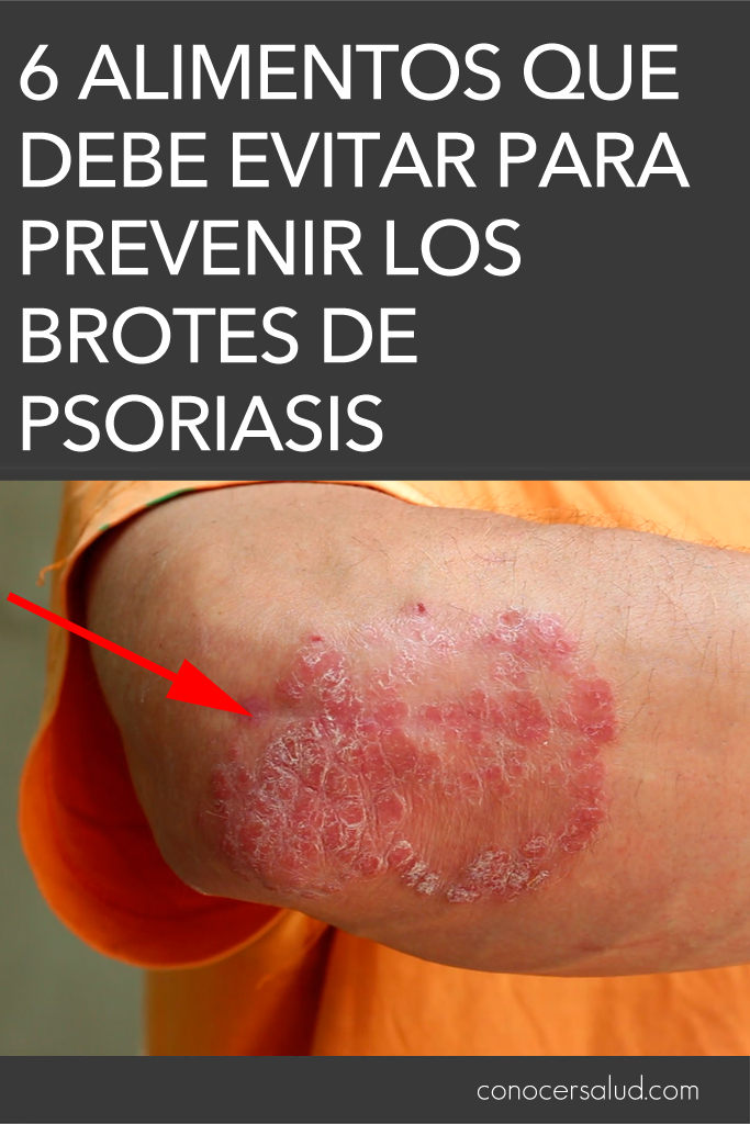 6 alimentos que debe evitar para prevenir los brotes de psoriasis