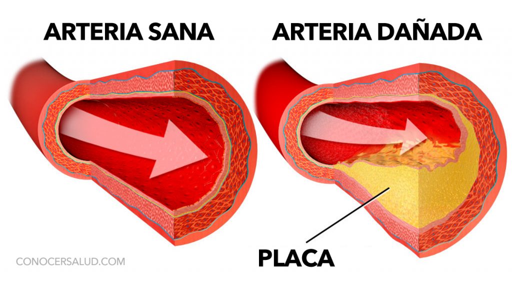 7 maneras simples de limpiar sus arterias naturalmente