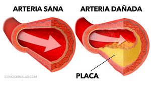 7 maneras simples de limpiar sus arterias naturalmente