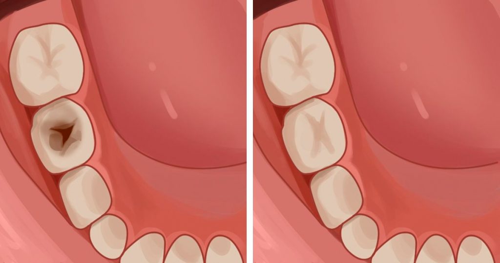 6 consejos efectivos para prevenir y reducir las caries naturalmente