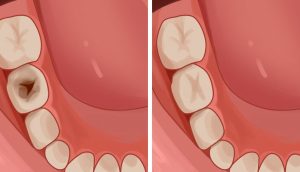 6 consejos efectivos para prevenir y reducir las caries naturalmente