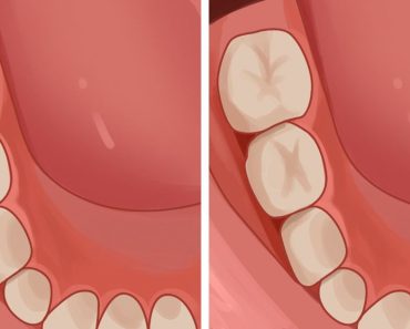 6 consejos efectivos para prevenir y reducir las caries naturalmente