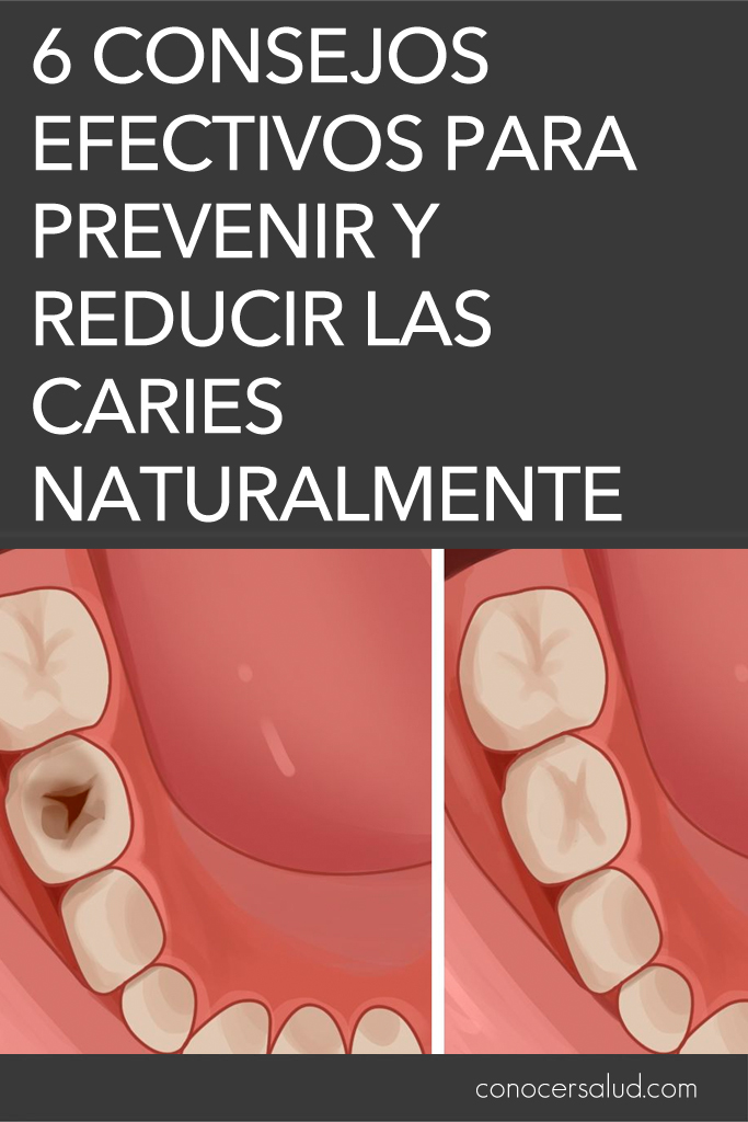 6 consejos efectivos para prevenir y reducir las caries naturalmente