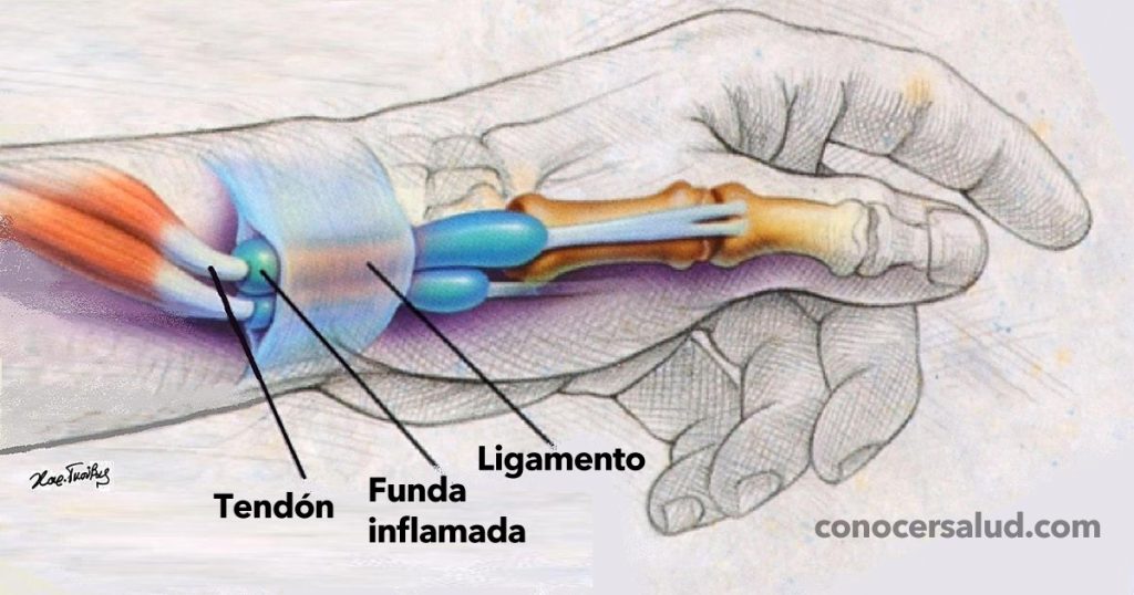 9 Ejercicios para curar la tendinitis o tenosinovitis de Quervain