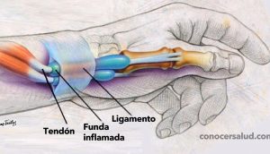 9 Ejercicios para curar la tendinitis o tenosinovitis de Quervain