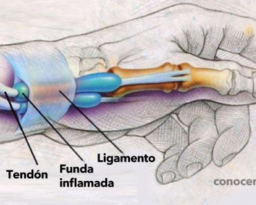 9 Ejercicios para curar la tendinitis o tenosinovitis de Quervain