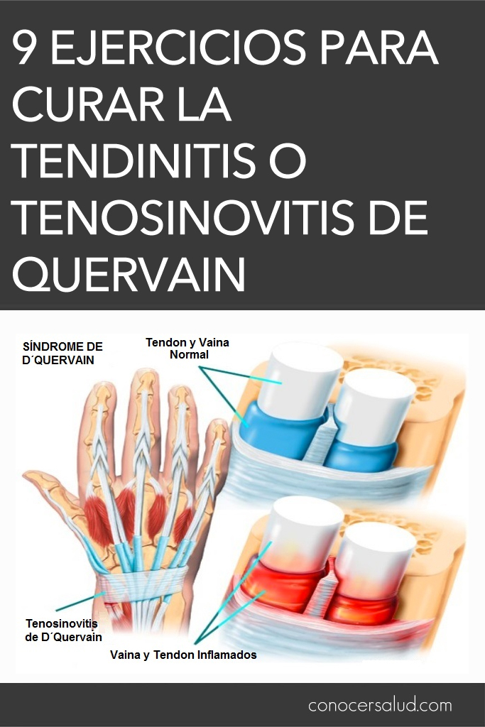 9 Ejercicios para curar la tendinitis o tenosinovitis de Quervain