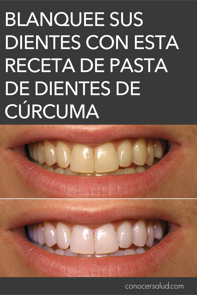 Blanquee sus dientes naturalmente con esta receta de pasta de dientes de cúrcuma