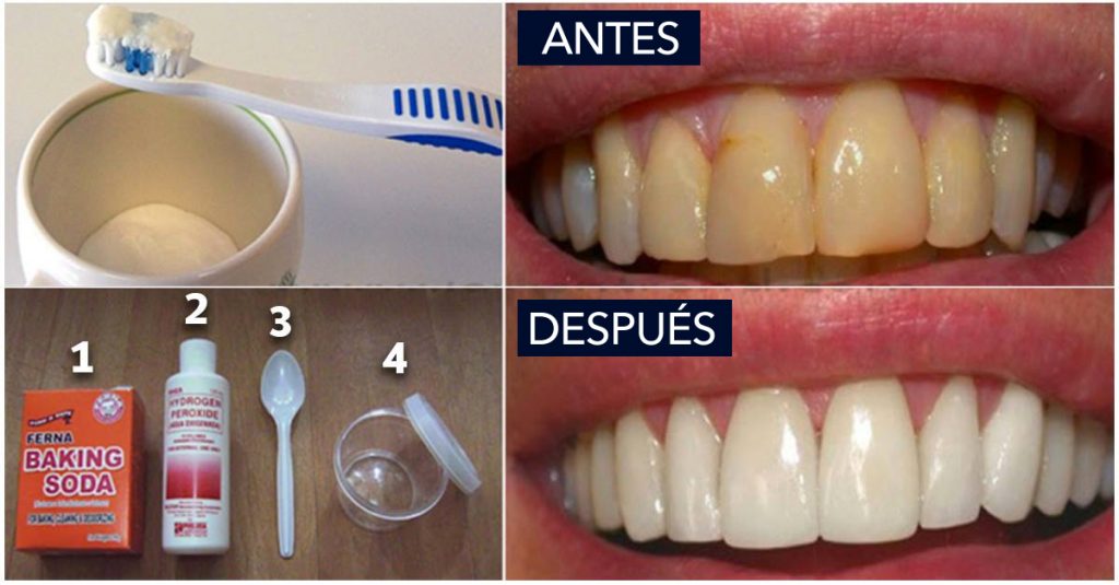 9 Remedios caseros para las encías retraídas que necesitas probar