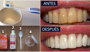 9 Remedios caseros para las encías retraídas que necesitas probar