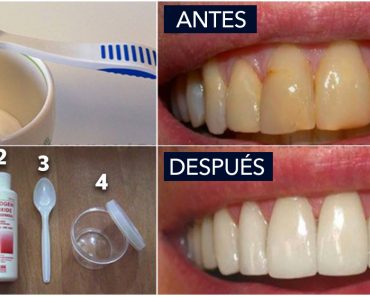 9 Remedios caseros para las encías retraídas que necesitas probar