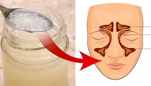 10 Remedios caseros para las infecciones de los senos paranasales: Alivie la sinusitis naturalmente