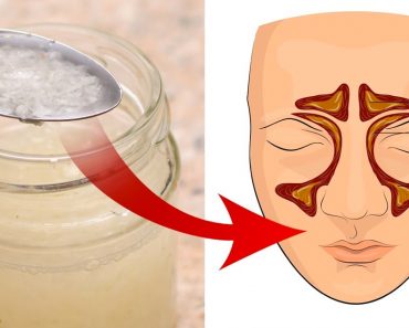 10 Remedios caseros para las infecciones de los senos paranasales: Alivie la sinusitis naturalmente