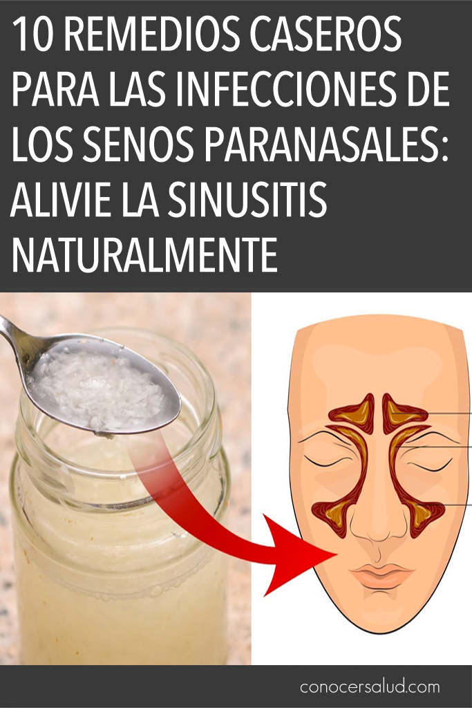 10 Remedios caseros para las infecciones de los senos paranasales: Alivie la sinusitis naturalmente