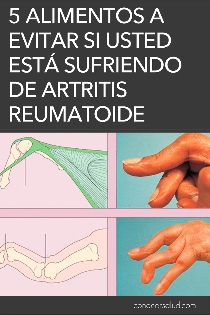 5 alimentos a evitar si usted está sufriendo de artritis reumatoide