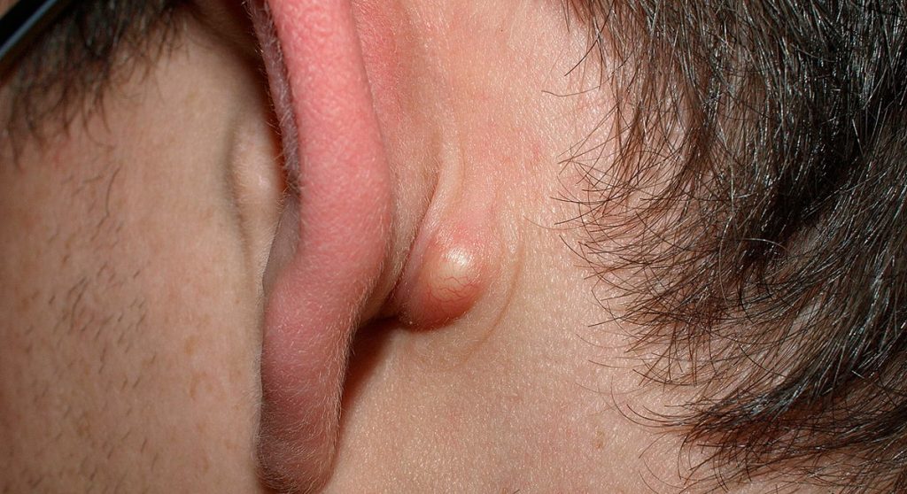 Todo lo que necesitas saber sobre ese bulto detrás de la oreja