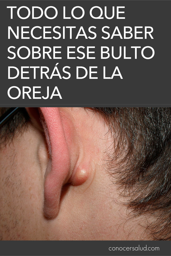 Todo lo que necesitas saber sobre ese bulto detrás de la oreja