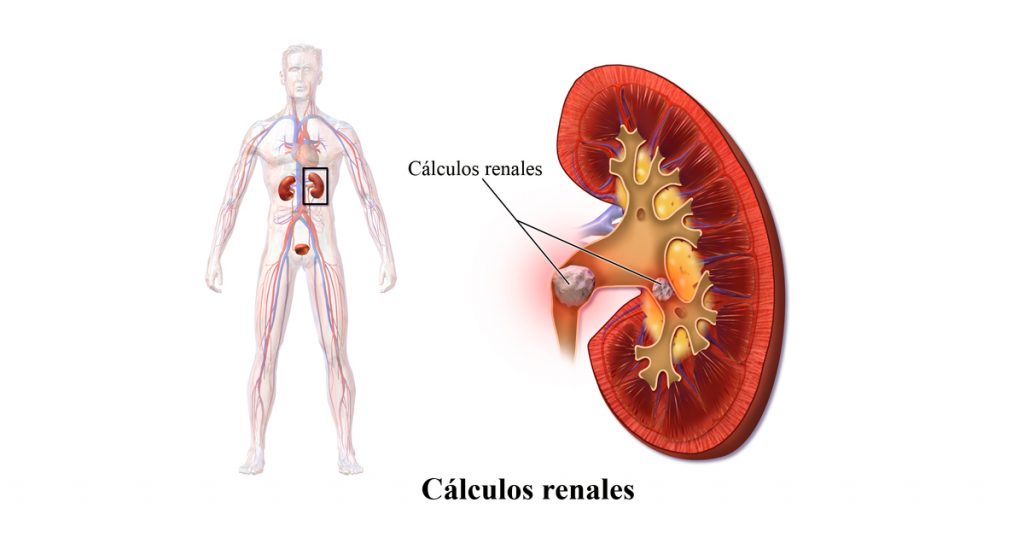 Cómo eliminar los cálculos renales naturalmente con sólo cuatro ingredientes