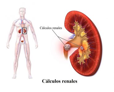 Cómo eliminar los cálculos renales naturalmente con sólo cuatro ingredientes