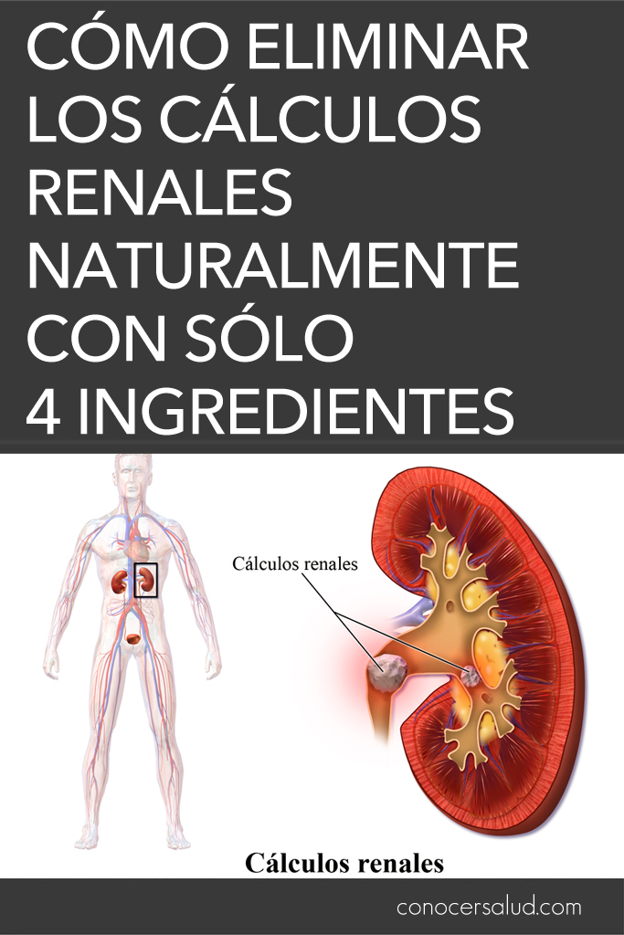 Cómo eliminar los cálculos renales naturalmente con sólo cuatro ingredientes