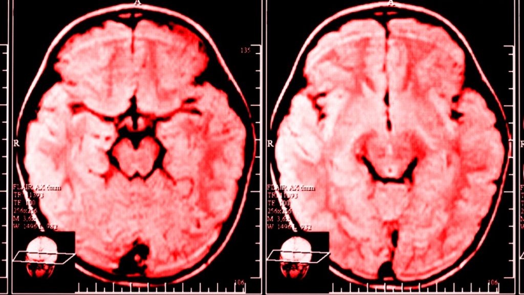 Investigación: quejarse cambia físicamente su cerebro para que esté ansioso y deprimido