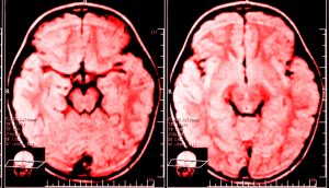 Investigación: quejarse cambia físicamente su cerebro para que esté ansioso y deprimido