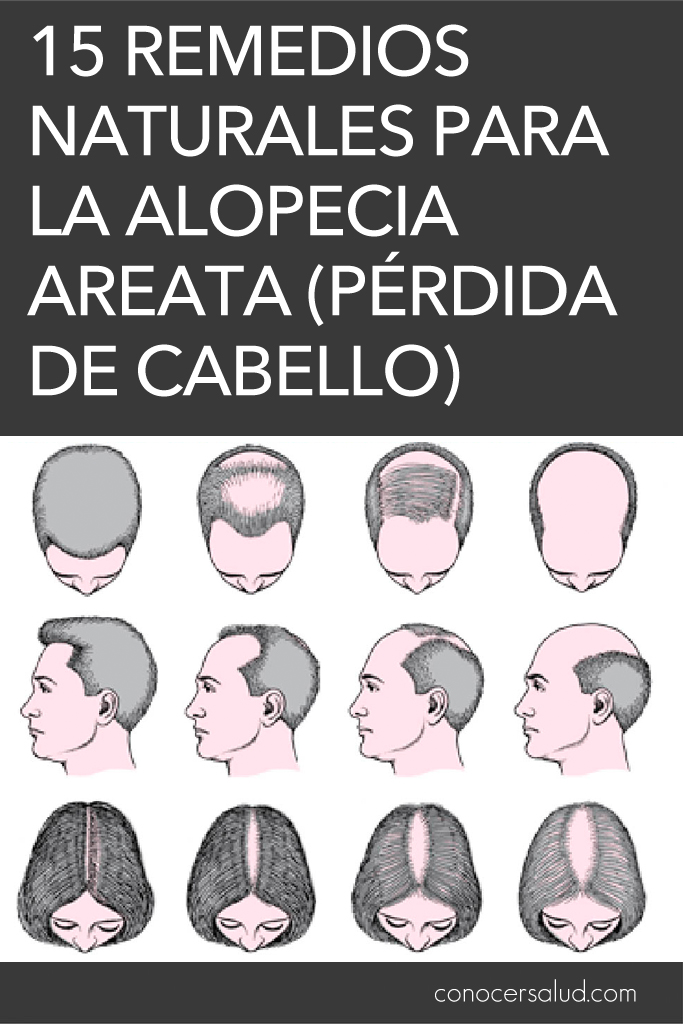 15 Remedios naturales para la alopecia Areata (pérdida de cabello)