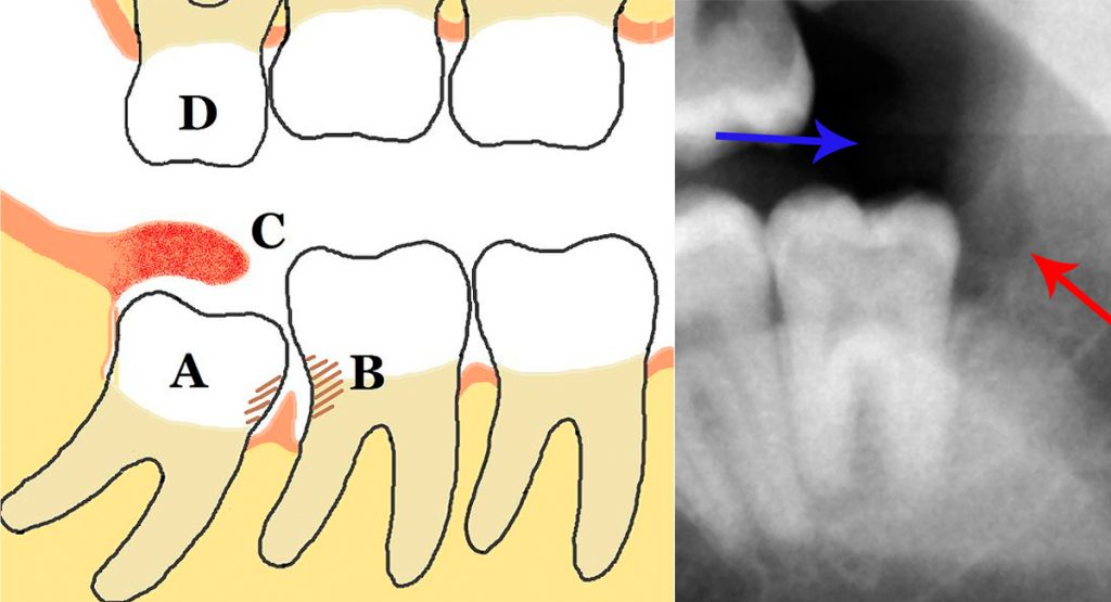 10 remedios caseros para el dolor y el malestar de la pericoronitis