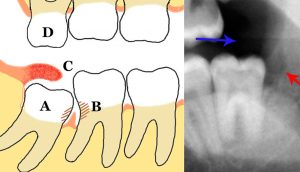 10 remedios caseros para el dolor y el malestar de la pericoronitis